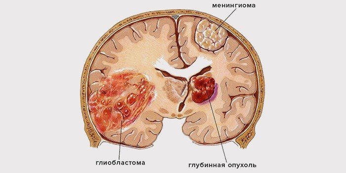 Создан новый препарат для лечения опухоли мозга